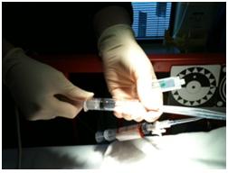 Nursing CPG Replogle gentley aspirating suction lumen Nursing CPG Replogle gentley aspirating suction lumen